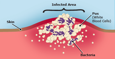 staphylococcus skin infections #10