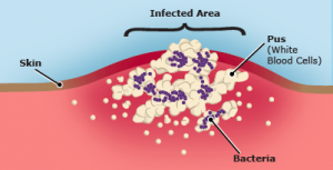 geanimeerde infectieopbouw