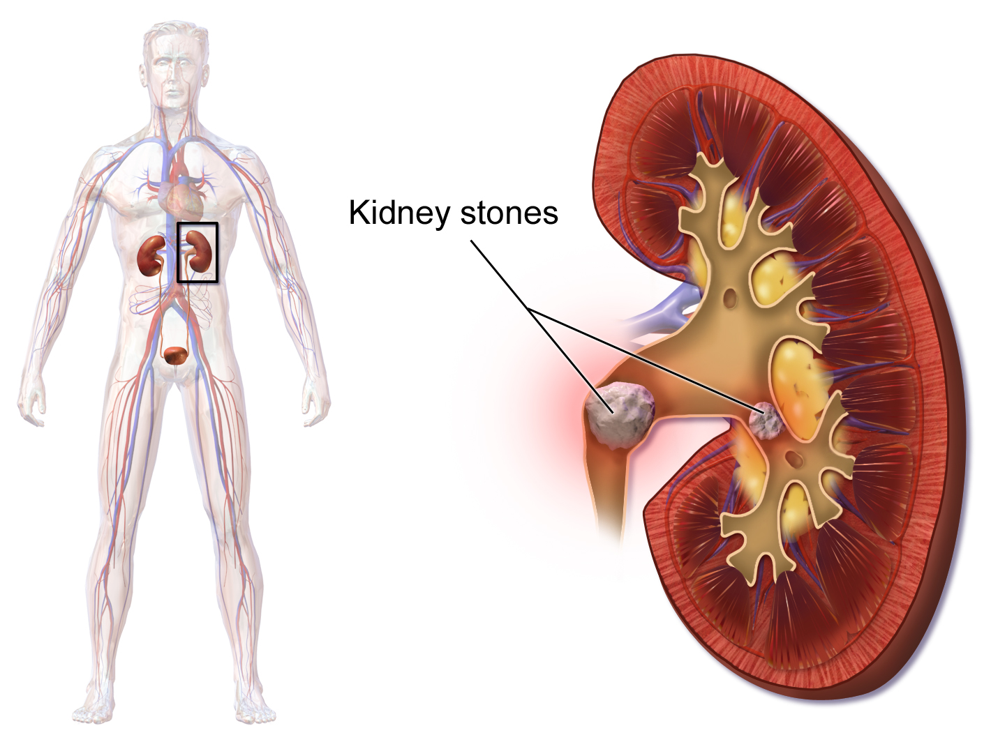 3D example kidney with kidney stones