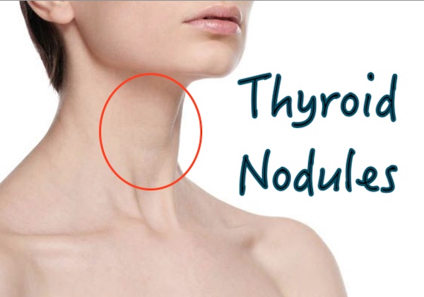 woman's inner neck area in red circle, text reading "Thyroid Nodules"